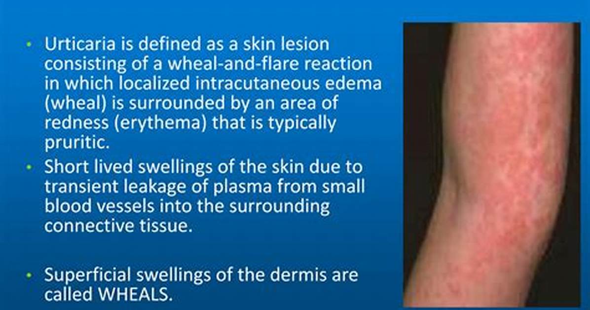 Where Does Urticaria Start?