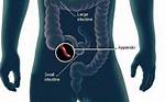 Where Is Appendix Located