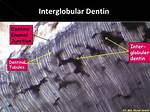 Where Is Interglobular Dentin Found?