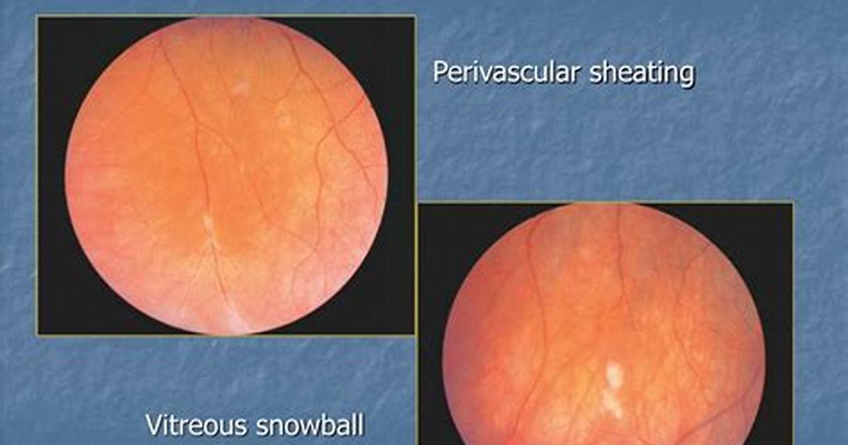 Where Is Intermediate Uveitis?