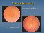 Where Is Intermediate Uveitis?