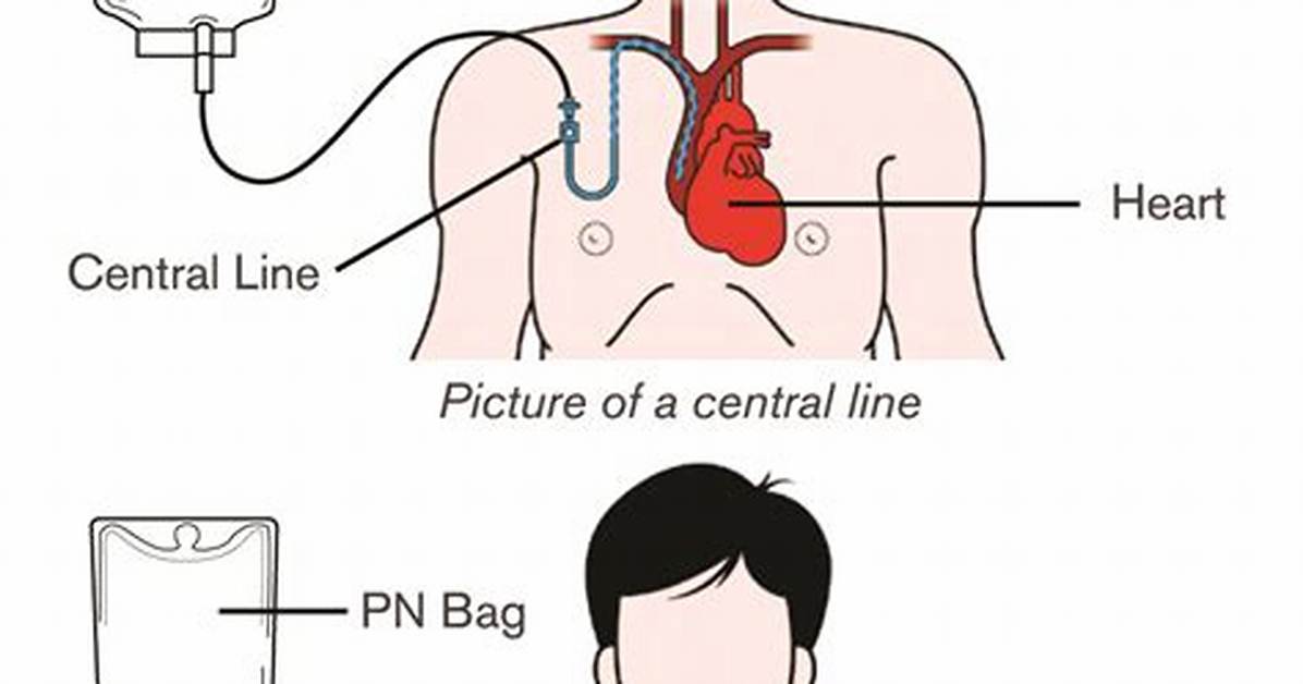 Where Is Tpn Inserted?