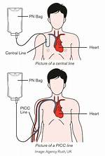 Where Is Tpn Inserted?