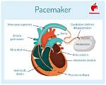 Where Pacemaker Come from?