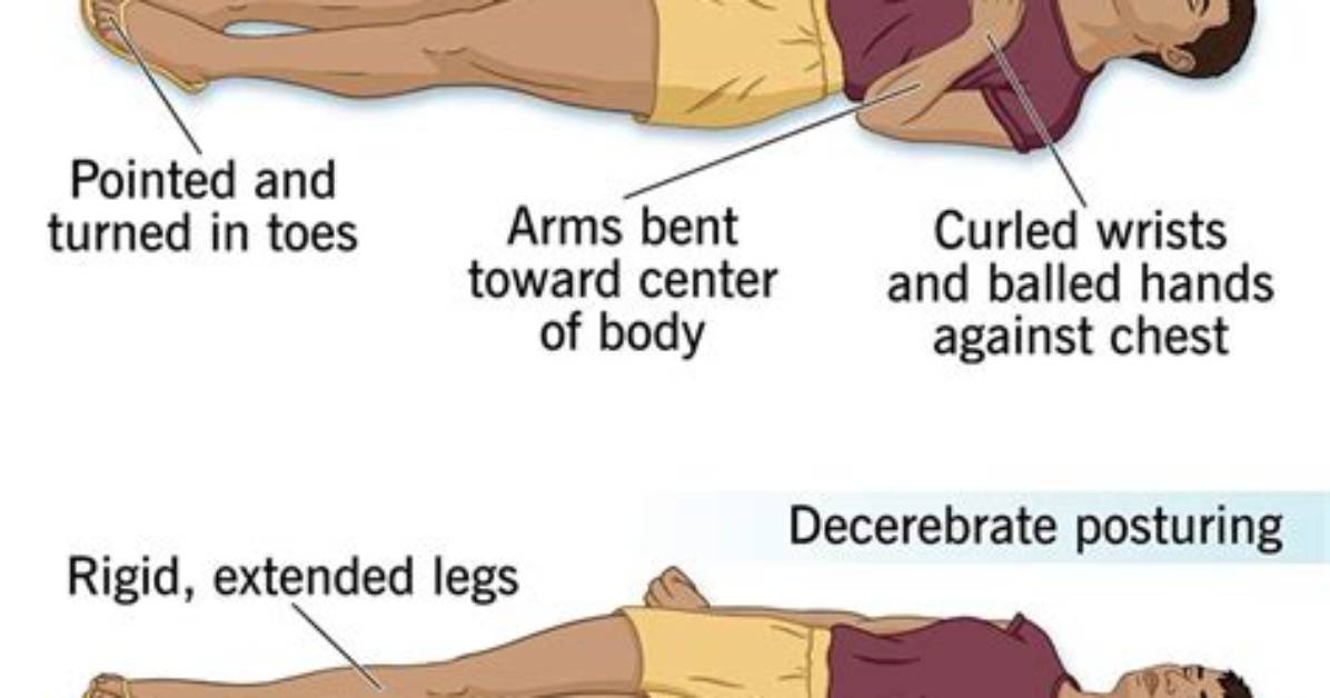 Which Best Describes Decorticate Posturing?