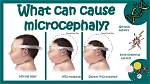 Which Can Cause Microcephaly?