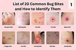 Which Insect Can Bite?
