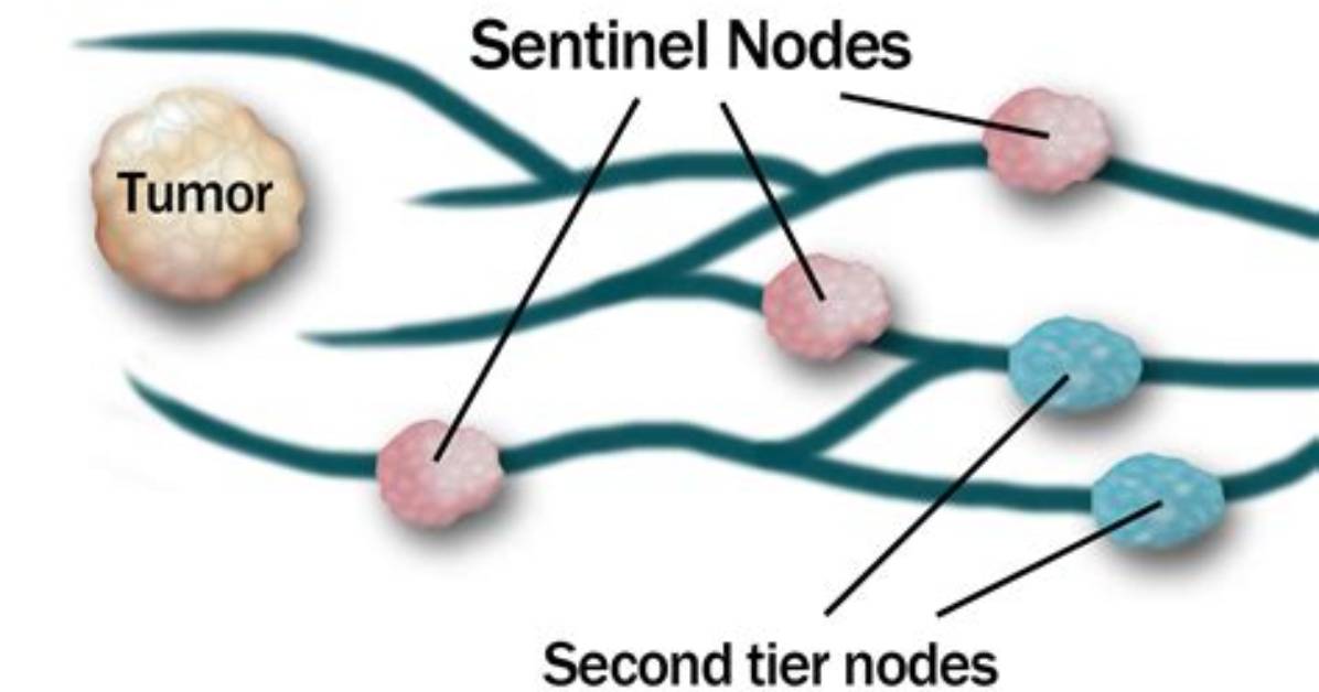 Which Is a Sentinel Node?