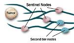 Which Is a Sentinel Node?