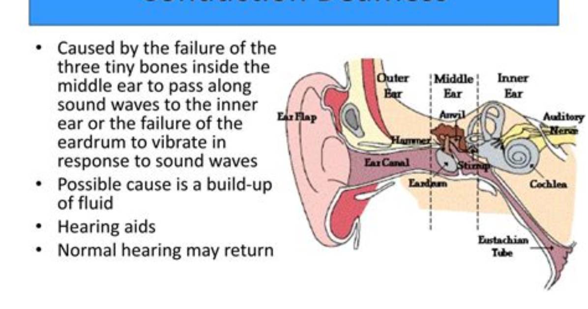 Which Is Conduction Deafness?