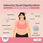 Which Thyroid Causes Weight Loss?