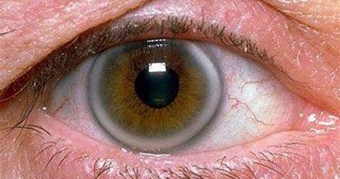 White Ring Around Iris