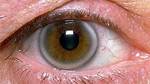 White Ring Around Iris