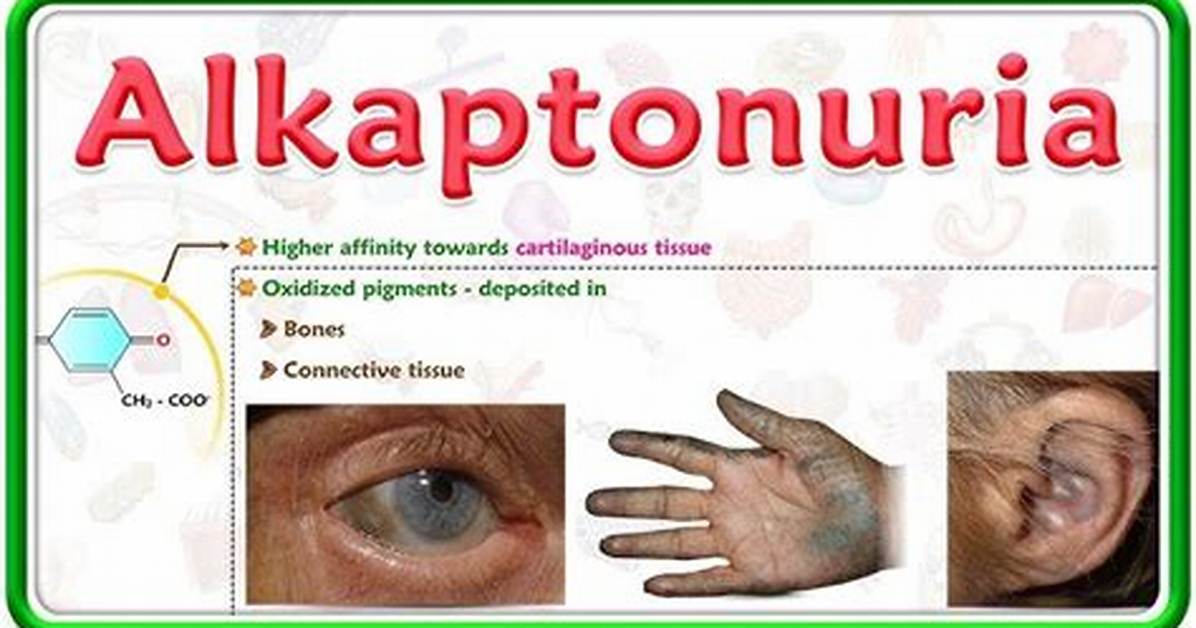 Who Does Alkaptonuria Affect?