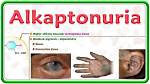 Who Does Alkaptonuria Affect?