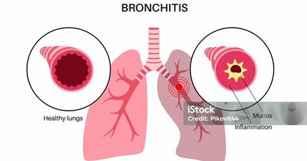 Who Does Bronchitis Affect?