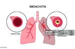 Who Does Bronchitis Affect?