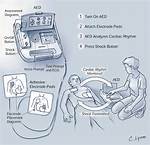 Who Does Defibrillator Work?