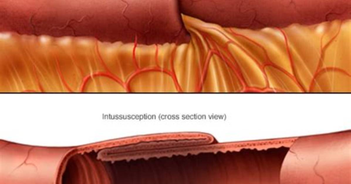 Who Does Intussusception Affect?