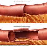 Who Does Intussusception Affect?