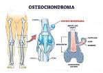 Who Does Osteochondroma Affect?