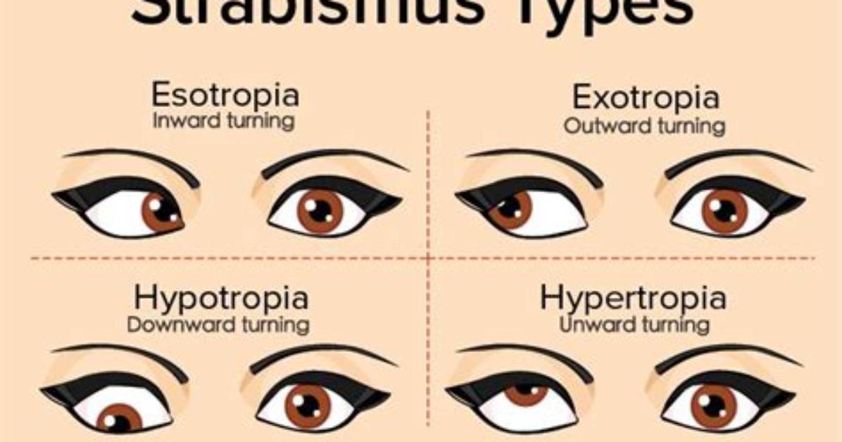 Who Does Strabismus Affect?