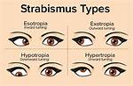 Who Does Strabismus Affect?