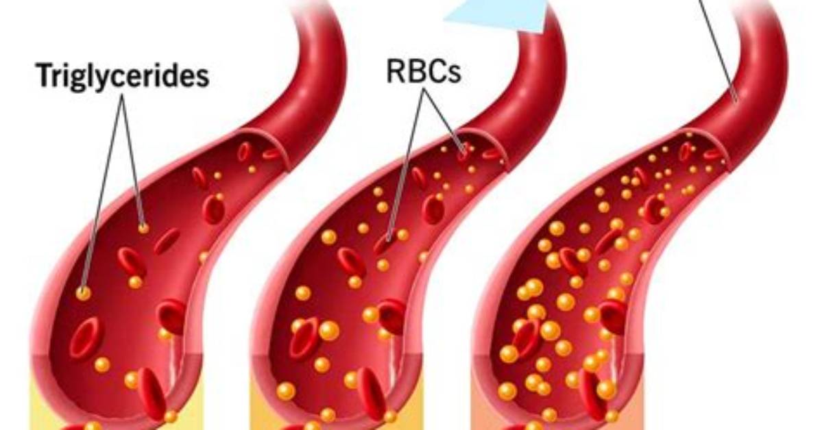 Who Does Triglycerides Test?