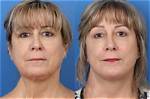 Who Gets Reconstructive Surgery?