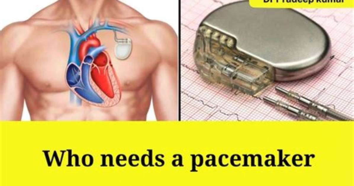 Who Needs a Pacemaker?