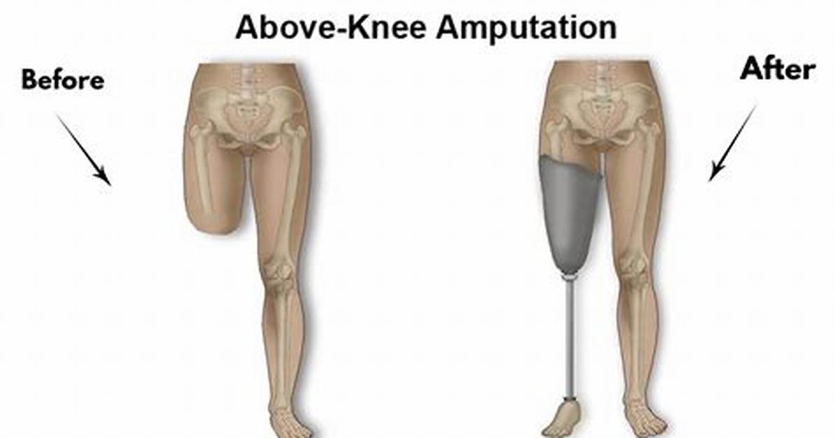 Who Performs Amputation Surgery?