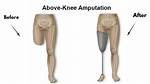 Who Performs Amputation Surgery?