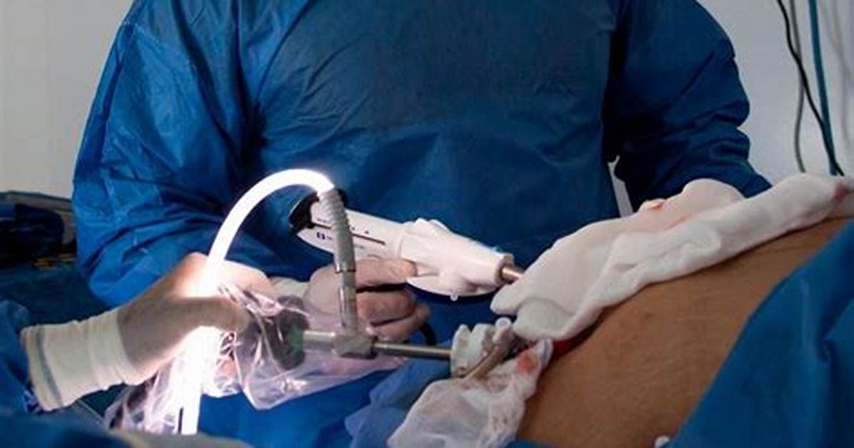 Who Performs Appendix Surgery?