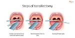 Who Performs Tonsillectomy Surgery?