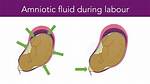 Why Amniotic Sac Breaks?