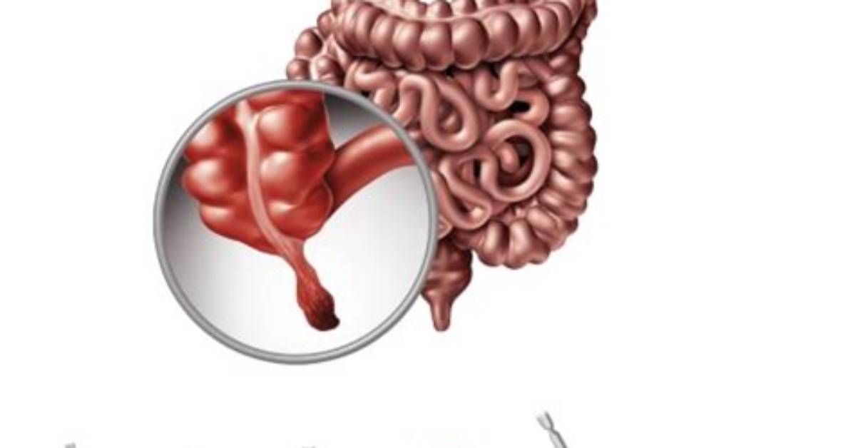 Why Appendix Operation Is Done?