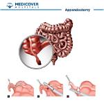 Why Appendix Operation Is Done?