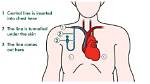 Why Are Central Lines Placed?
