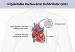 Why Are Defibrillators Implanted?