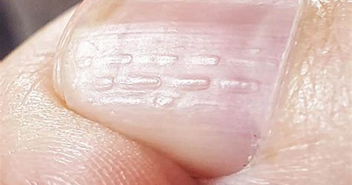 Why Are My Nails Bumpy?