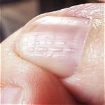Why Are My Nails Bumpy?