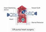 Why Beating Heart Surgery?