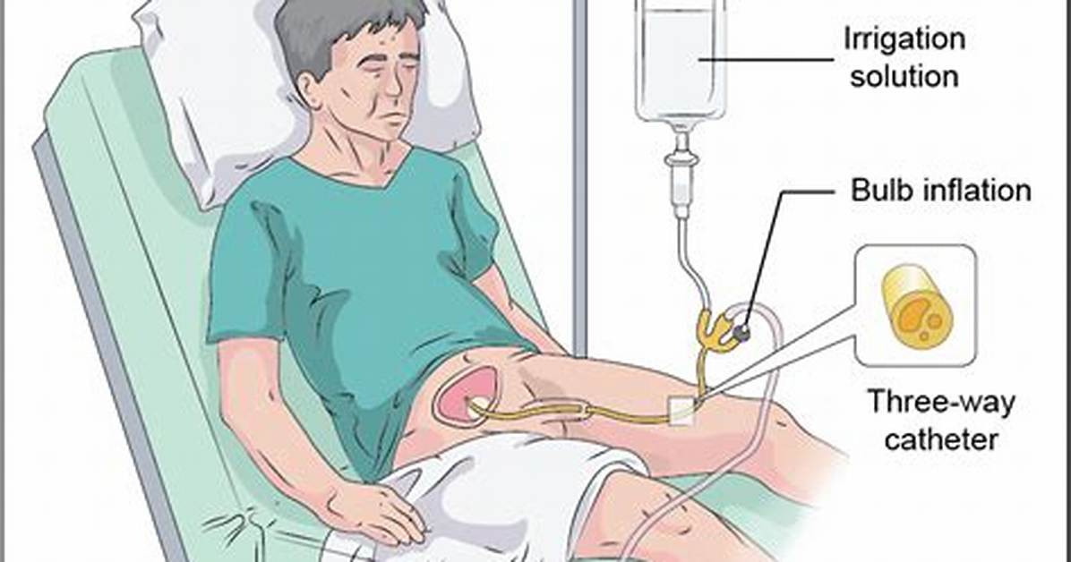 Why Continuous Bladder Irrigation?