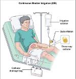 Why Continuous Bladder Irrigation?