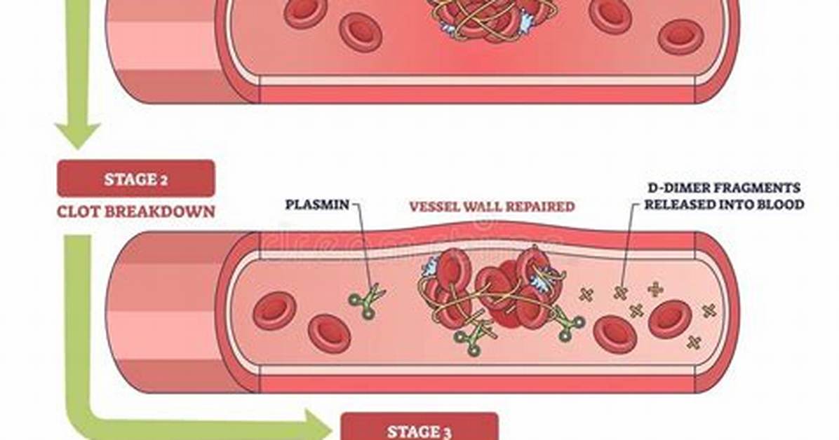 Why D Dimer Elevates?