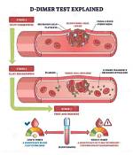 Why D Dimer Test Is Done?