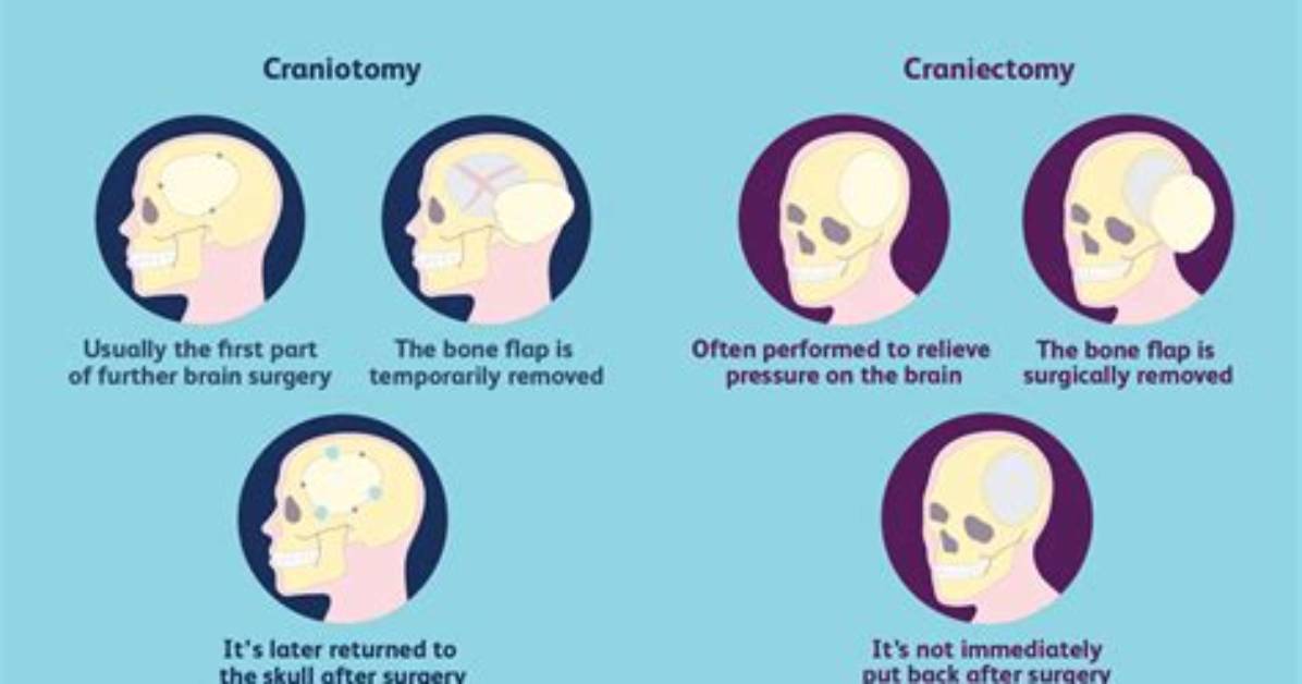 Why Do a Craniotomy?