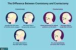 Why Do a Craniotomy?