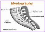 Why Do a Myelography?