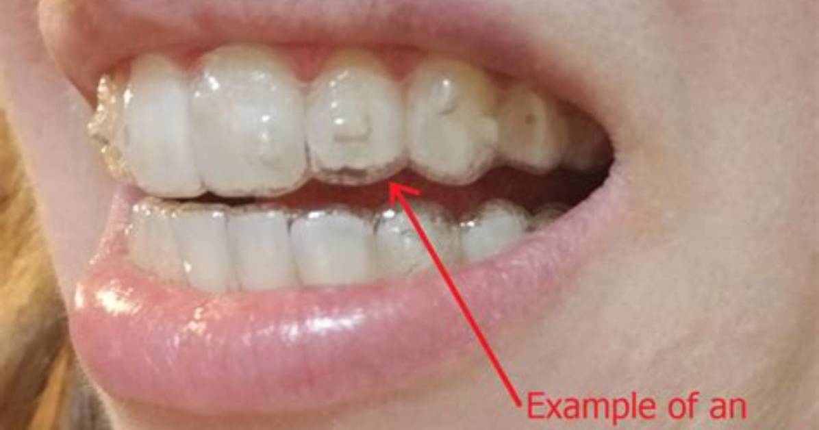 Why Do Aligners Get Loose?